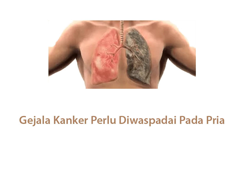 Gejala Kanker Perlu Diwaspadai